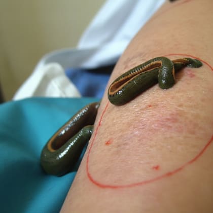 Raktamokshana — Bloodletting Therapy