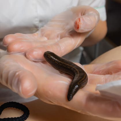 Leech therapy — classical bloodletting practice